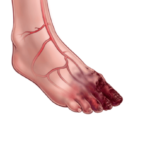 Caladrius Biosciences Foot Illustration