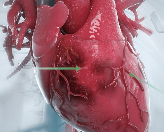 Heart rendering describing how CD34+ regenerative therapy works